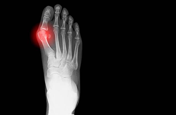 Why Modern Bunion Surgery in Houston Is Nothing Like the Horror Stories You’ve Heard